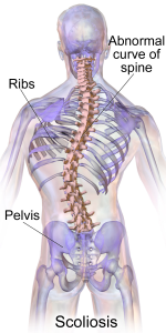 Orleans Chiropractor Scoliosis